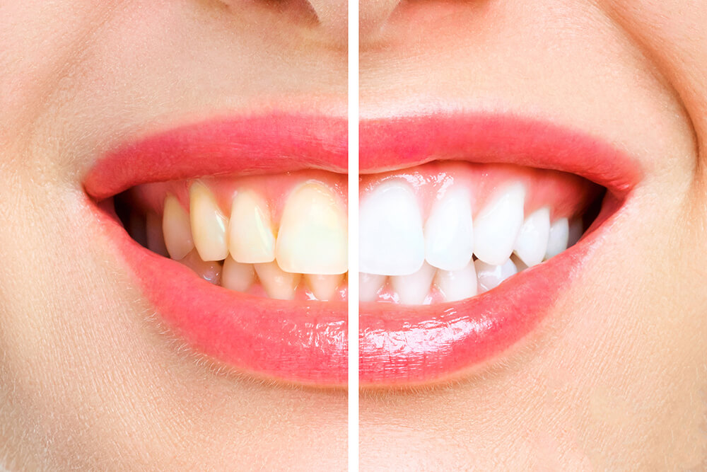 Antes y despues blanqueamiento dental