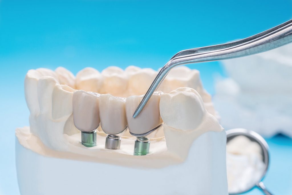 implante dental