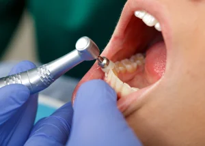 dentistas portugalete limpieza dental